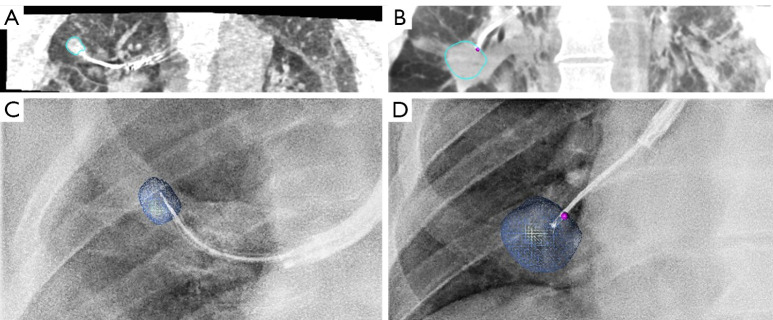 Navigation bronchoscopy imaging: CT and fluoroscopy views