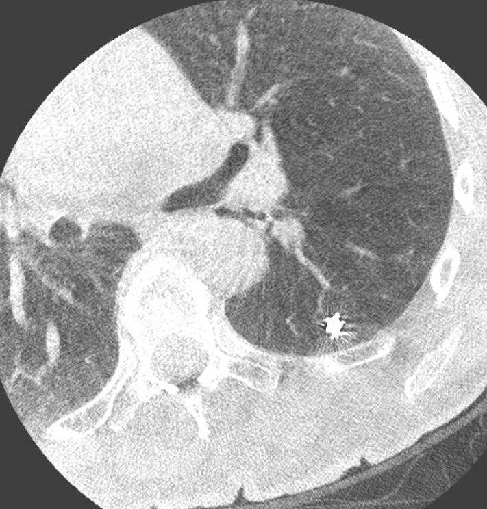 Cone-beam CT confirmation of tool-in-lesion