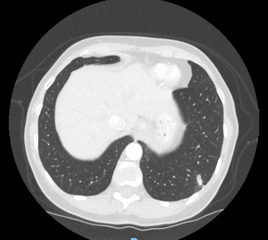 CT scan showing left lower lobe nodule