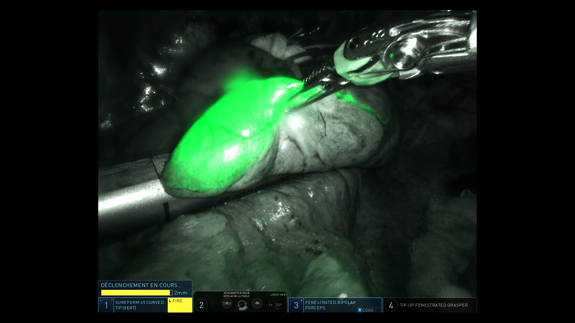 ICG fluorescence during surgery