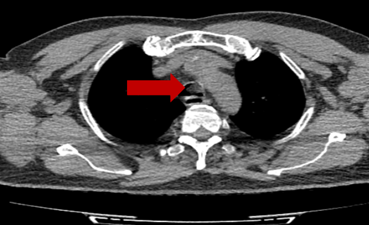 Thoracic CT showing intraluminal tracheal lesion