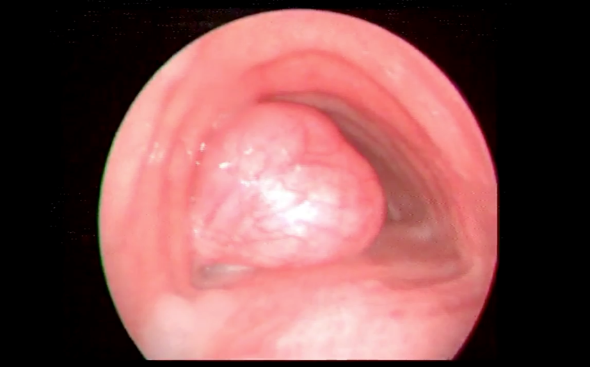 Bronchoscopic view of pedunculated lesion