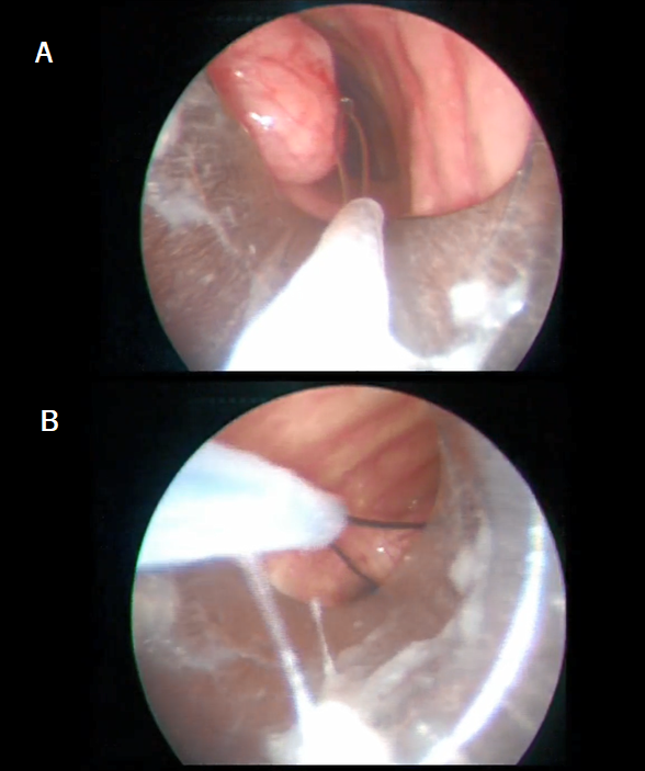 Snare electrocautery resection