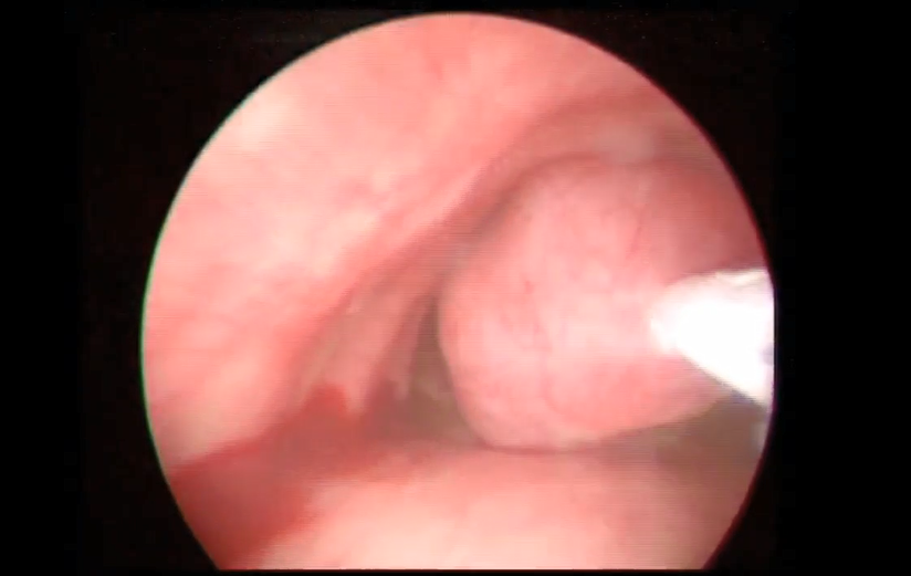 Cryoprobe retrieval