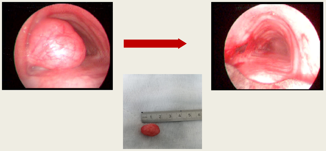 Final bronchoscopic appearance, restored tracheal lumen
