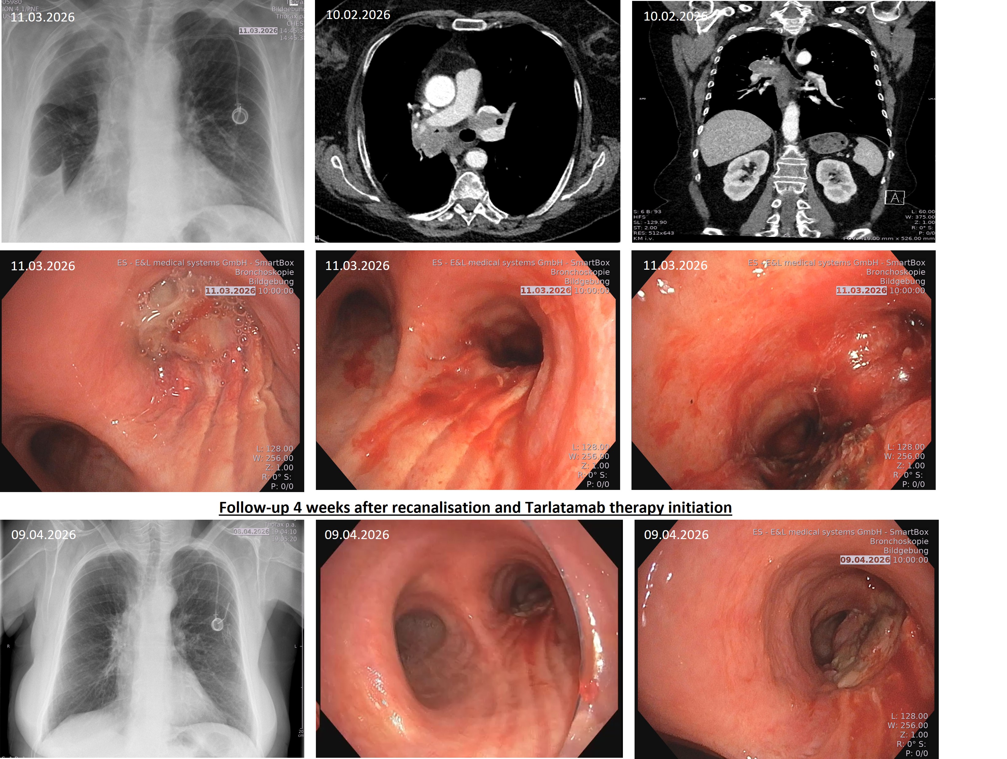 Multimodal imaging and bronchoscopy before and after recanalisation and Tarlatamab