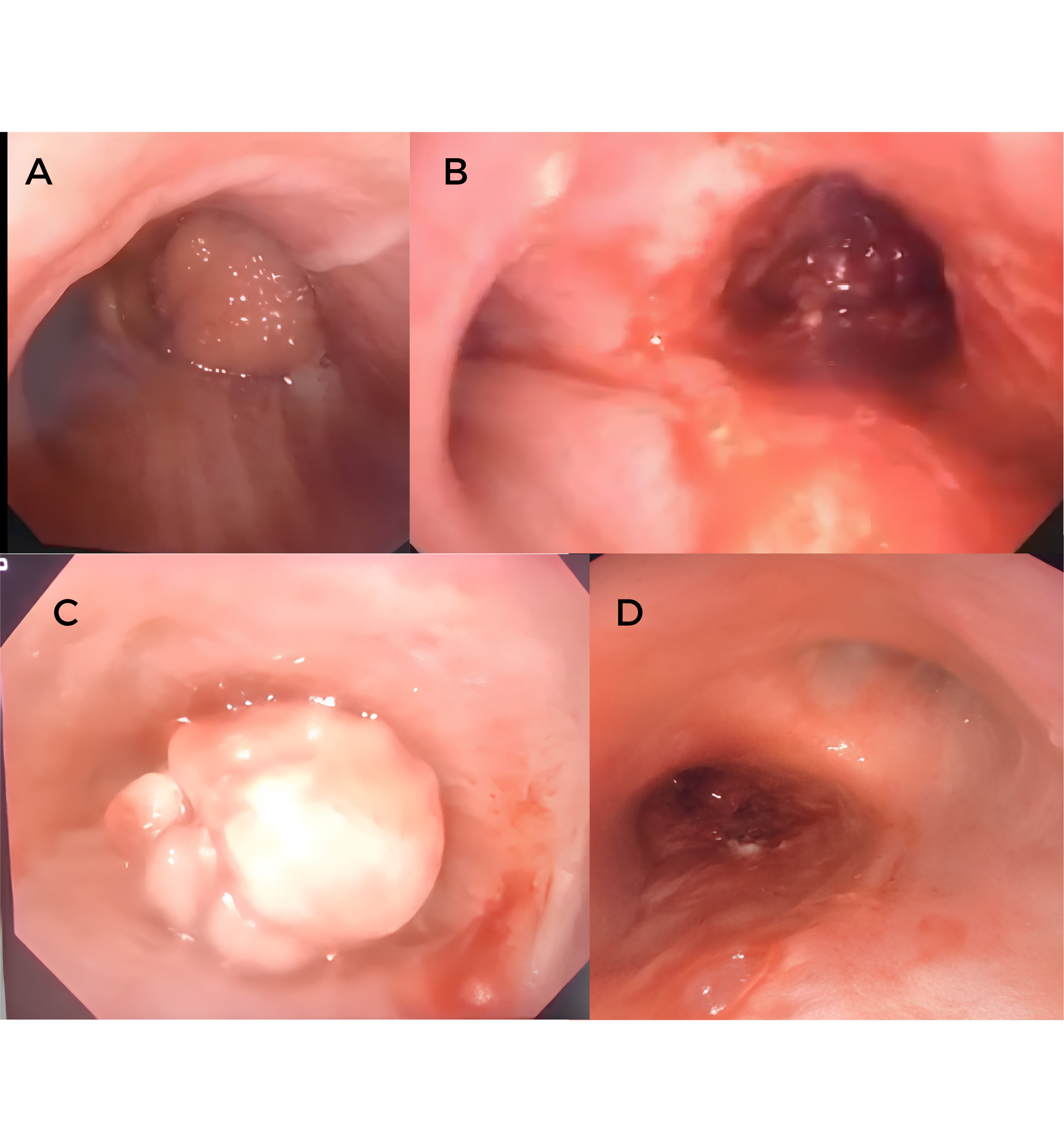 Bronchoscopic views during staged debulking