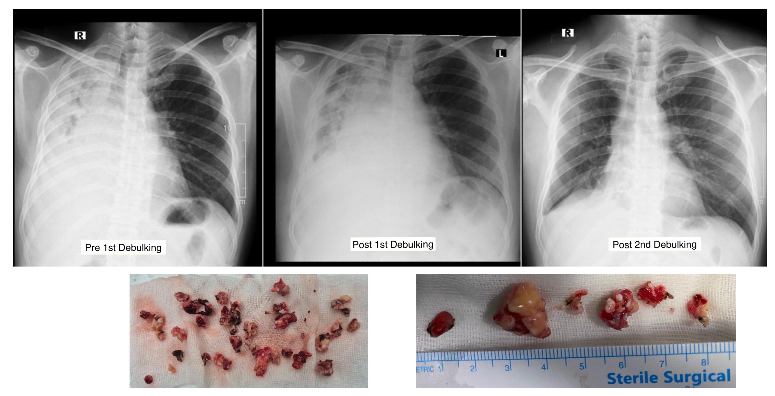 Serial chest X-rays and macroscopic specimens