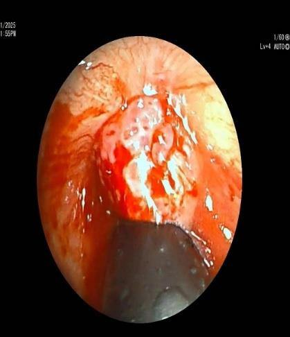 Bronchoscopic image of vascular tracheal mass causing near complete occlusion