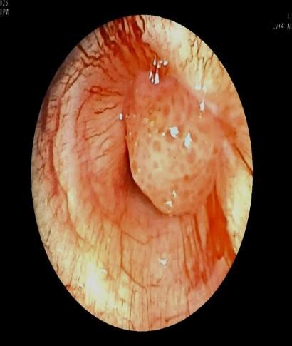 Placement of Microlaryngeal tube distal to the mass
