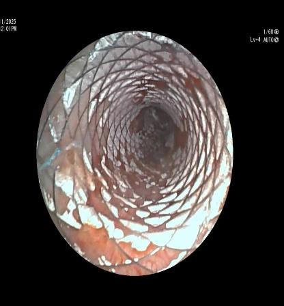 Post tracheal SEMS placement