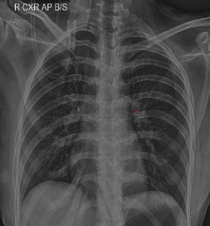 Post procedure chest X-ray