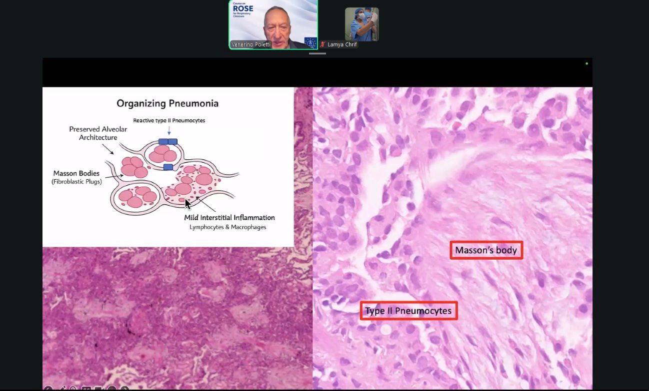 Course slide showing organising pneumonia histology, Masson's body and type II pneumocytes