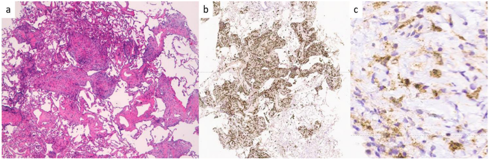Histopathology and immunohistochemistry of an inflammatory myeloid neoplasm sampled by cryobiopsy