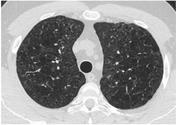HRCT showing the cystic and nodular pattern of pulmonary Langerhans cell histiocytosis