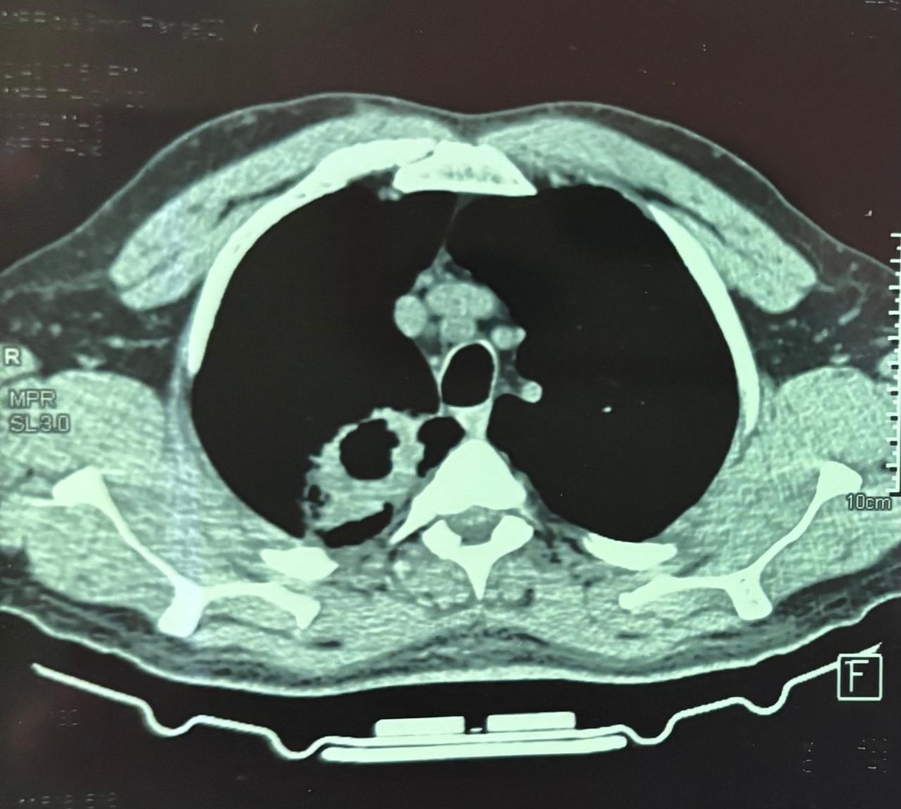 Axial CT, excavated right upper lobe lesion