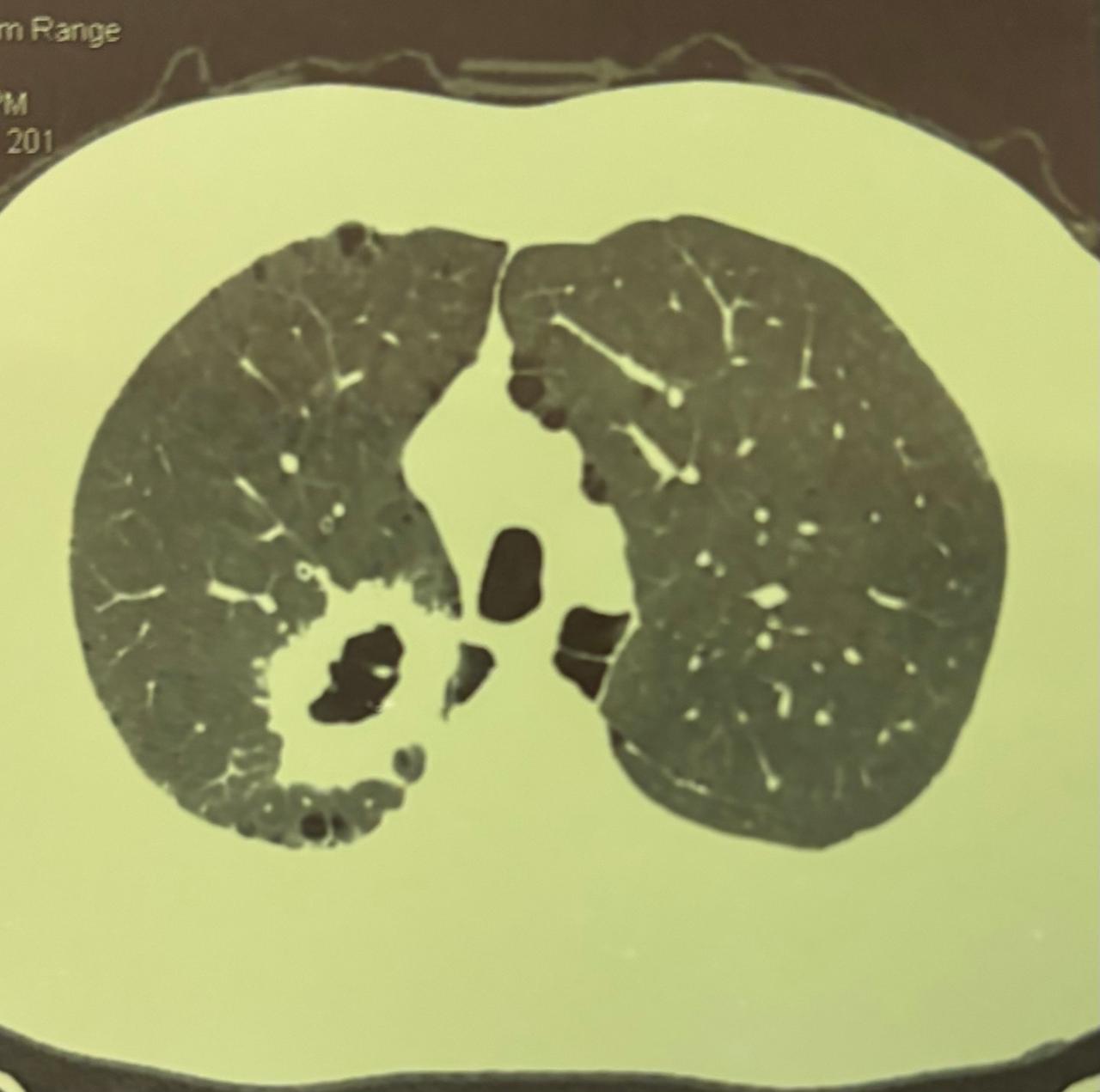 Axial CT lung window, cavitated lesion with surrounding parenchymal changes