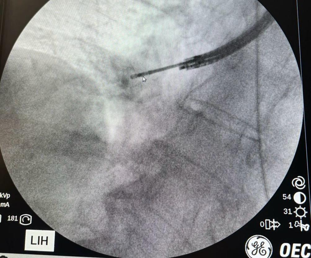 Fluoroscopic guidance during cryoprobe positioning
