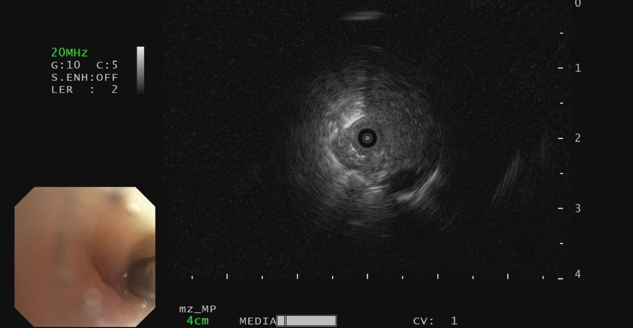 Radial EBUS image confirming probe position within the lesion