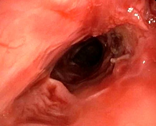 Rigid bronchoscopy, dilatation of the stenotic segment