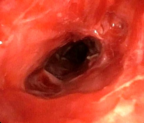 Dilatation with tubes of increasing caliber