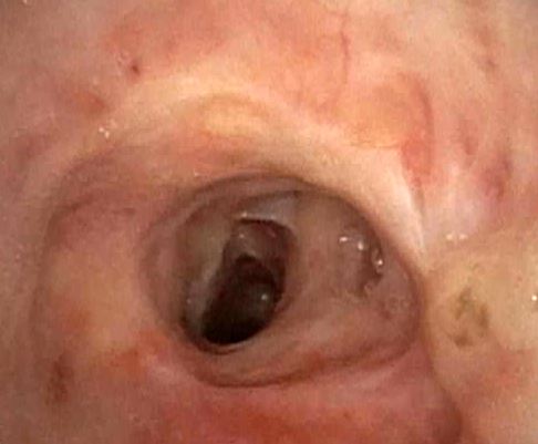 Endoscopic follow-up after stent placement
