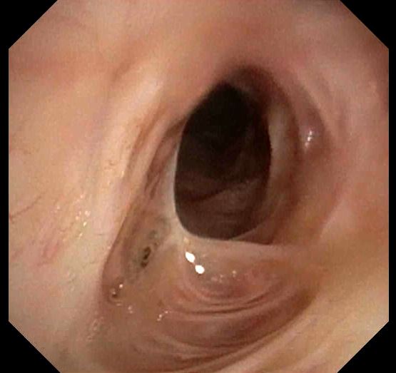 Endoscopic view showing stent-related changes before final decision