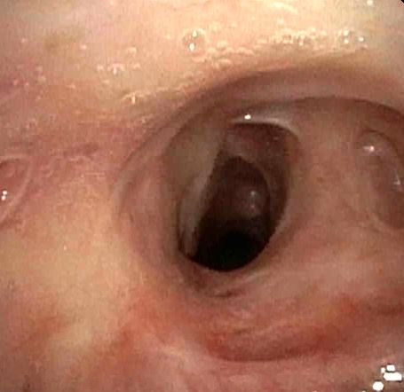 Endoscopic view of the complex tracheal stenosis before treatment