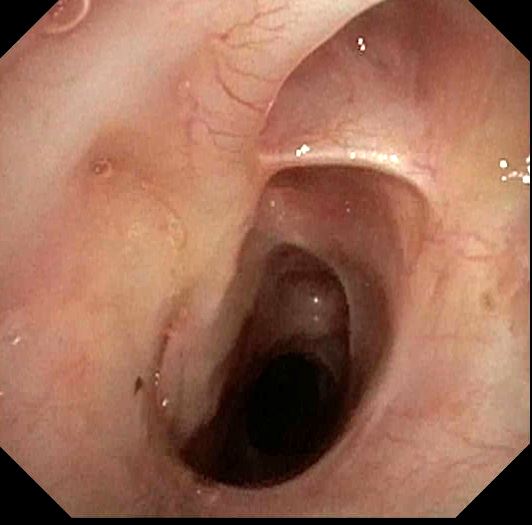 Endoscopic view, tortuous and fibrotic airway lumen