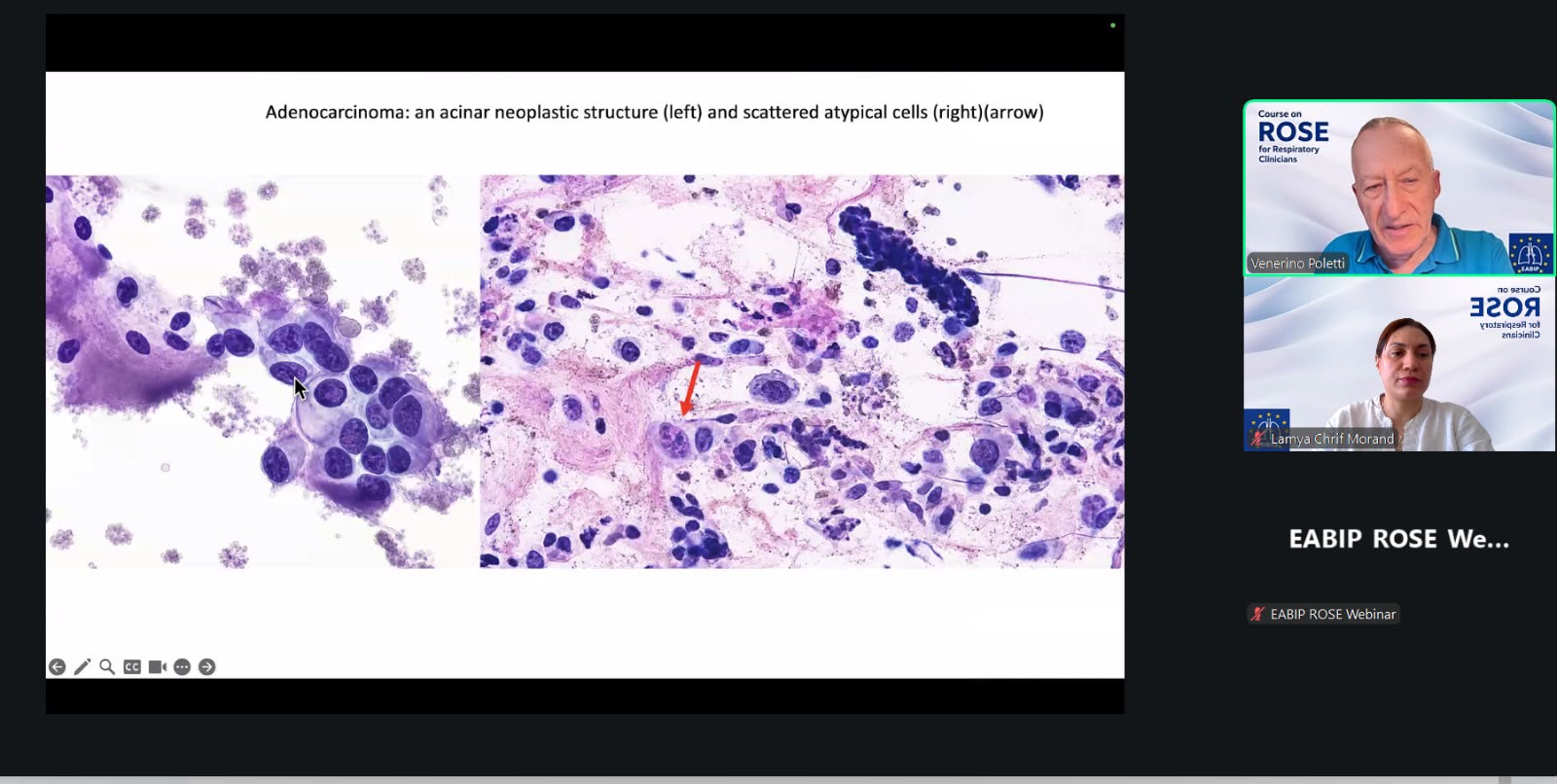 Teaching slide: adenocarcinoma, acinar neoplastic structure and scattered atypical cells
