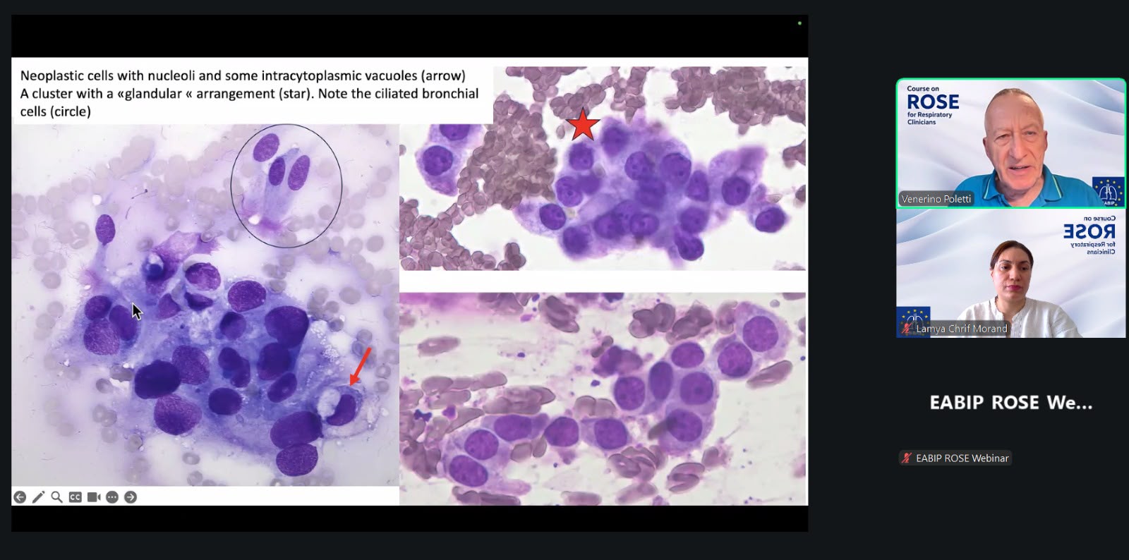 Teaching slide: neoplastic cells with nucleoli, glandular arrangement and ciliated bronchial cells